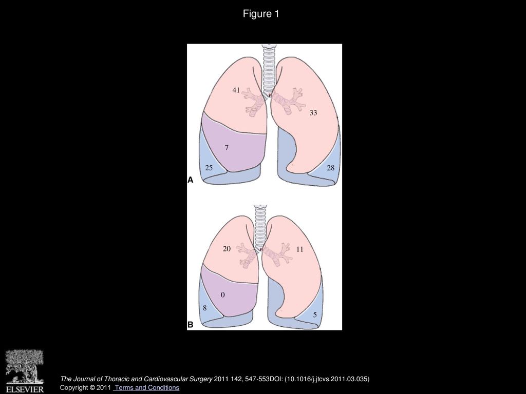 Figure 1 Location of non–small cell lung cancer: A, all tumors; B, bilateral tumors.