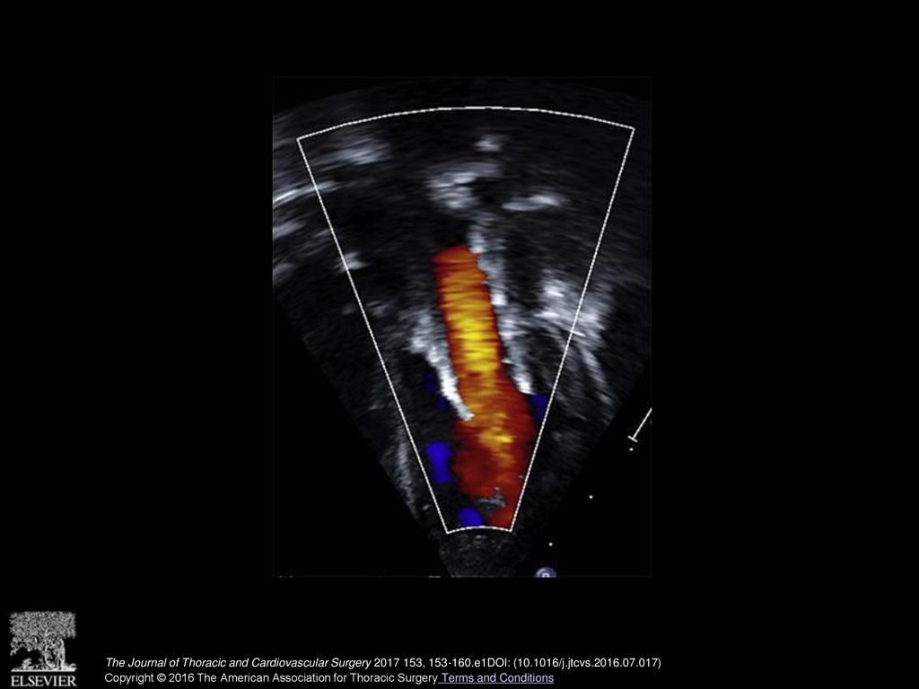 Echocardiographic image of the Melody valve in the mitral position in a young child.