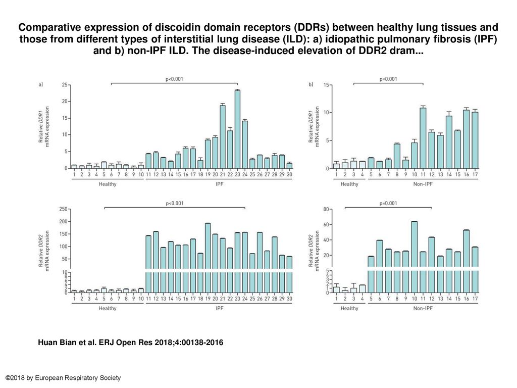 Comparative expression of discoidin domain receptors (DDRs) between healthy lung tissues and those from different types of interstitial lung disease (ILD): a) idiopathic pulmonary fibrosis (IPF) and b) non-IPF ILD. The disease-induced elevation of DDR2 dram...