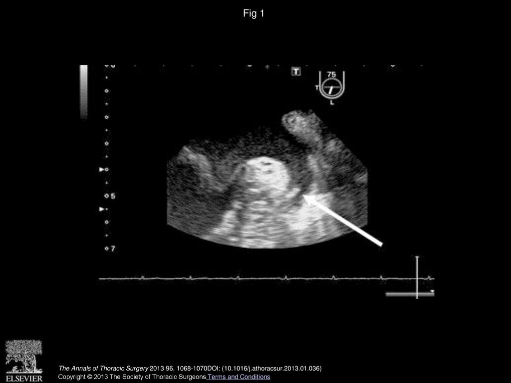 Fig 1 Transesophageal echocardiogram. View of the auricle of the atrial appendage, showing an elongated image measuring 7 × 3 mm.