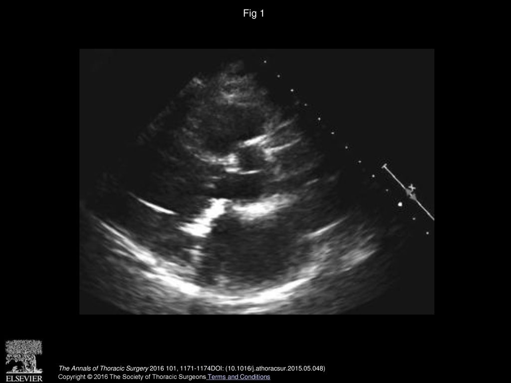 Fig 1 Preoperative transthoracic echocardiography showed severe calcified mitral stenosis and mitral annular calcification.