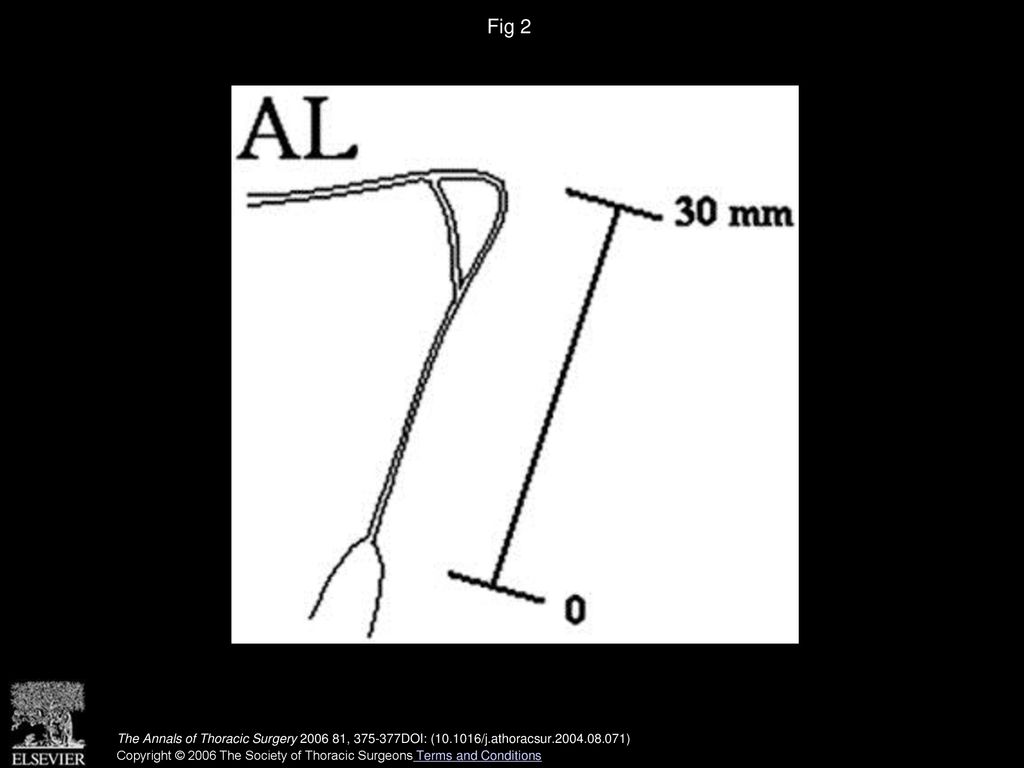 Fig 2 When the mitral valve is exposed, the elongated chorda is measured with a ruler. In this case, the length is 30 mm. (AL = anterior leaflet.)