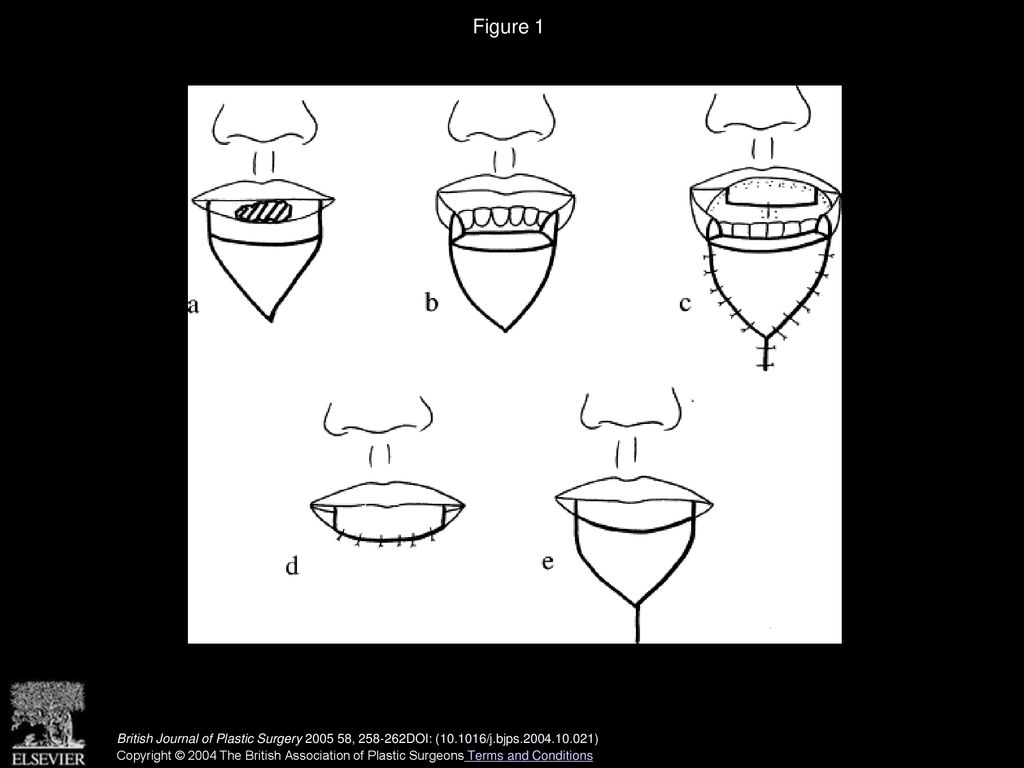 Combined Tongue Flap And V Y Advancement Flap For Lower Lip Defects Ppt Download