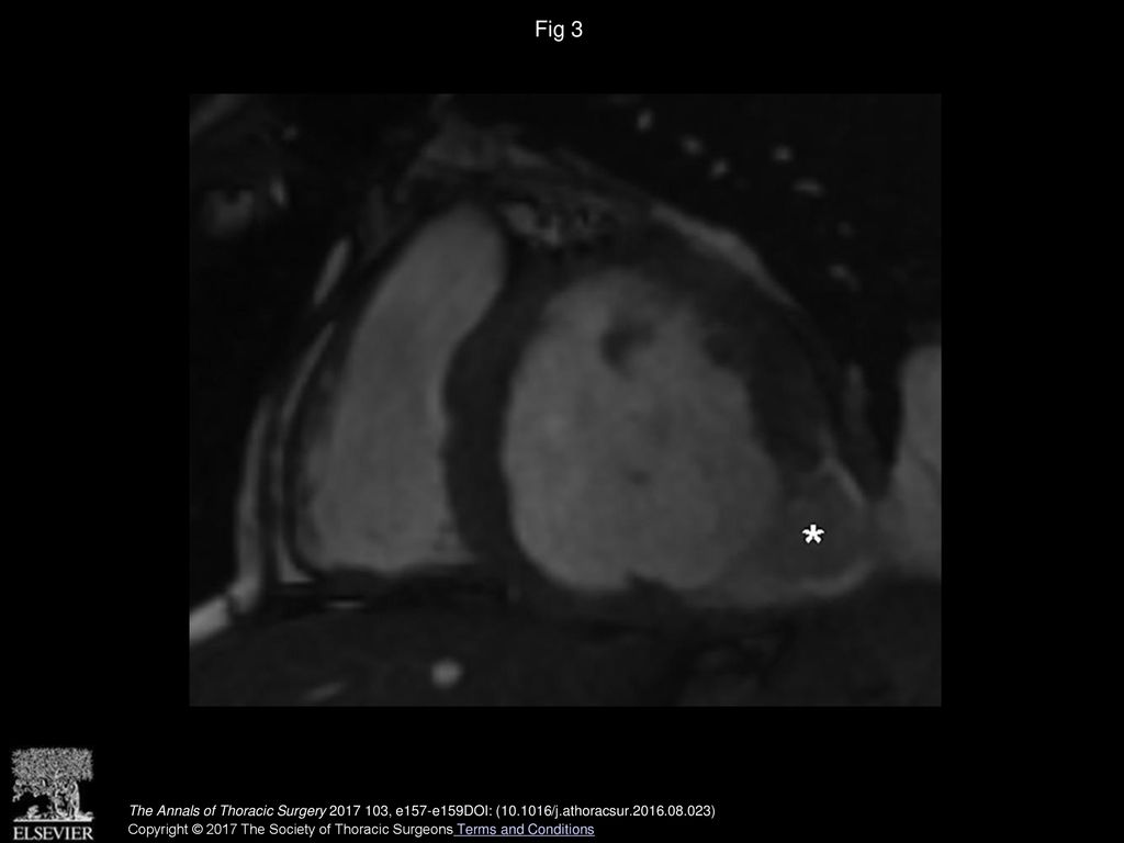 Fig 3 Postoperative cardiac magnetic resonance image. Exclusion of left ventricular (LV) pseudoaneurysm and ventricular reconstruction (∗).