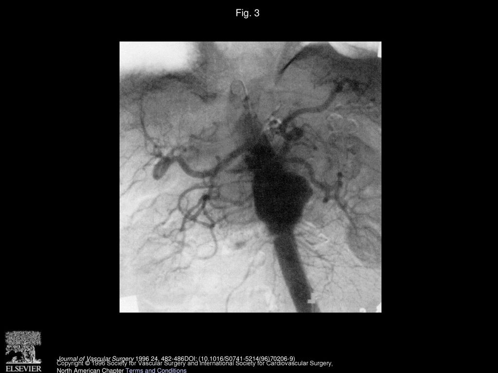 Fig. 3 Visceral arteriogram demonstrates saccular suprarenal extent of aneurysm with graft below.