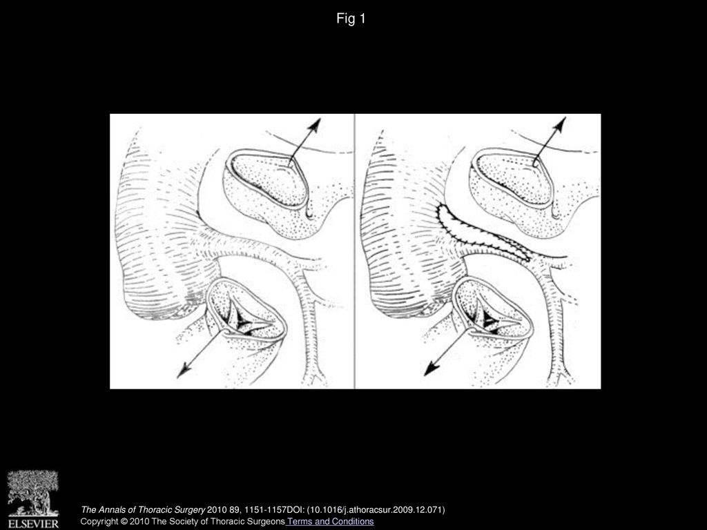 Fig 1 Transpulmonary anterior approach and surgical patch plasty of the left main coronary artery.