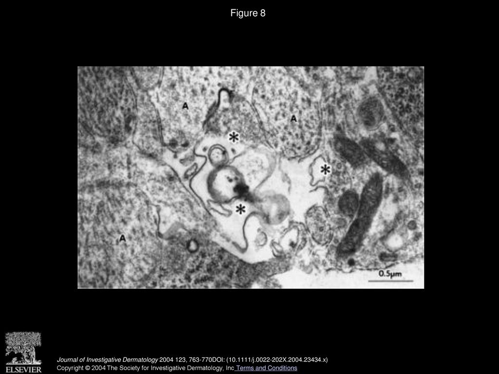 Figure 8 Electron microscopy. Sixteenth fetal day. There are degenerated axons (asterisks), which are neighboring to normal axons (A) × 40,000.