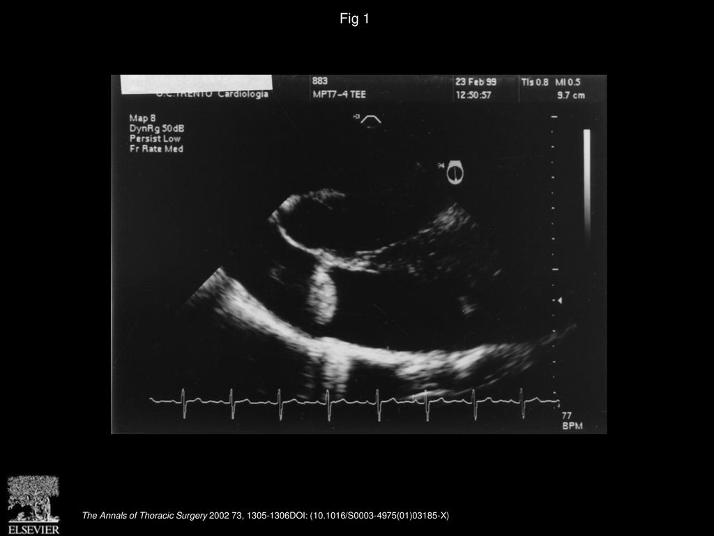 Fig 1 Pulmonary valve lipoma: transesophageal echocardiographic finding.