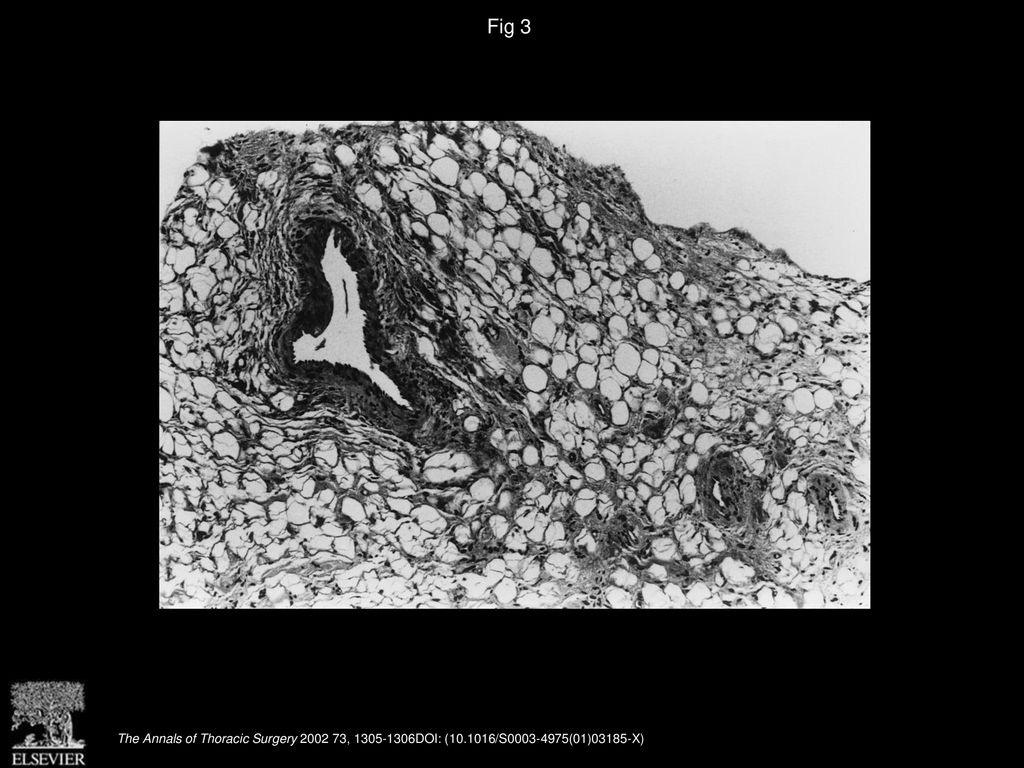Fig 3 Histologic aspect of the lesion.