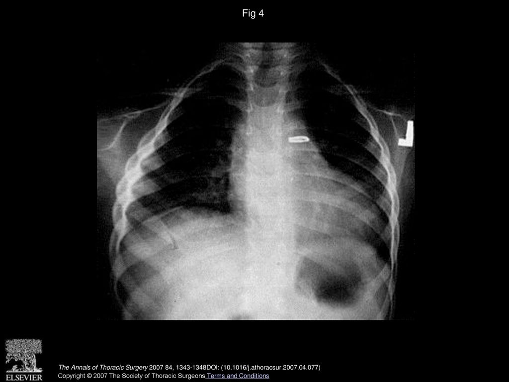 Fig 4 Chest x-ray film shows the clips on patent ductus arteriosus.
