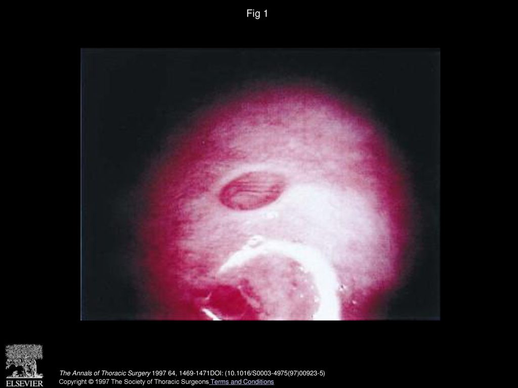 Fig 1 Left breast status after sternotomy and internal mammary artery harvest.