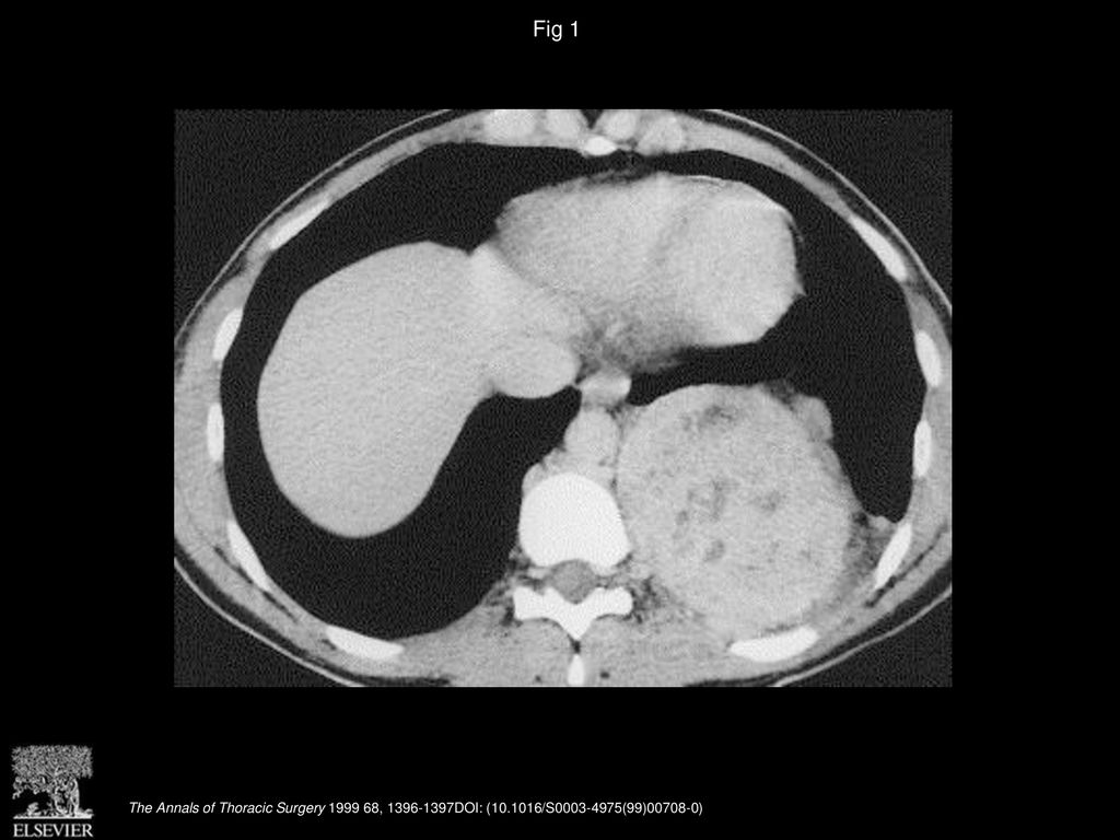 Fig 1 Computed tomographic scan of the chest depicting a 12-cm diameter, mixed attenuation, well circumscribed, posterior mediastinal mass.