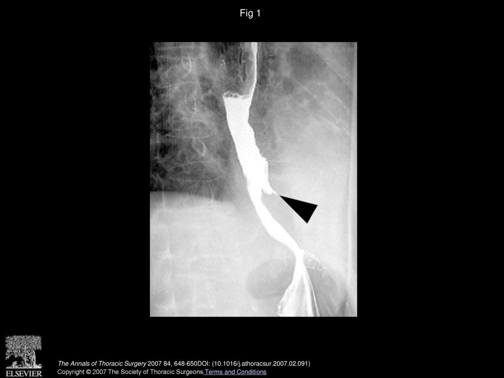 Fig 1 Upper gastrointestinal double contrast barium study revealing a small traction diverticulum in the mid-lower esophagus (arrowhead).