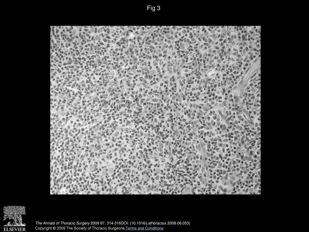 Fig 3 Microscopical pathology of re-biopsied mediastinal mass demonstrated Kimura s disease. (Hematoxylin and eosin; ×400.)