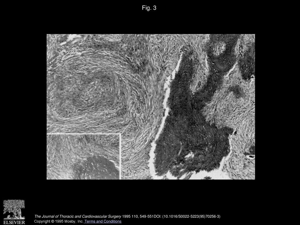 Fig. 3 Metaplastic bone formation within tumor. (Hematoxylin and eosin; original magnification × 63; inset × 160.)