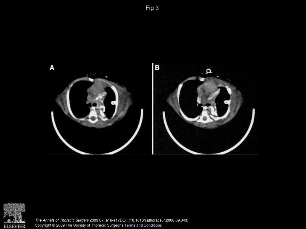 Fig 3 (A, B) A postoperative chest computed tomography angiography shows resolution of the mediastinal abscesses and adequate left bronchial repair.