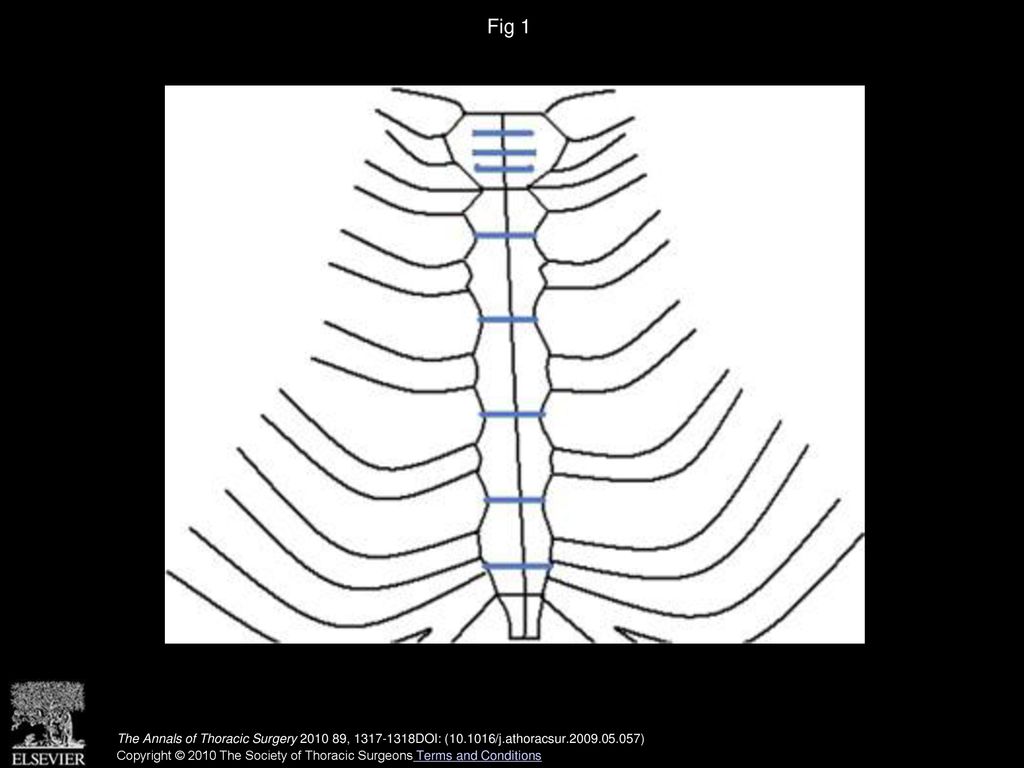 Fig 1 Schematic diagram depicts conventional sternal closure method. Blue lines represent placement of sternal wires.