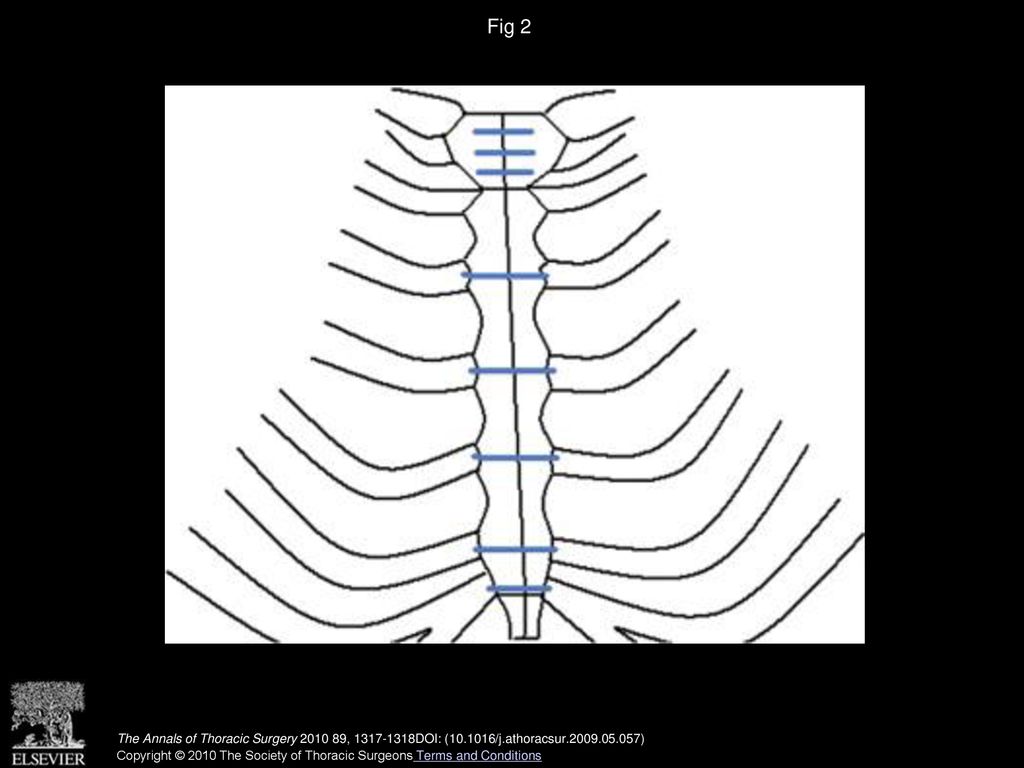 Fig 2 Schematic diagram depicts the transcostal sternal closure method. Blue lines represent placement of sternal wires.