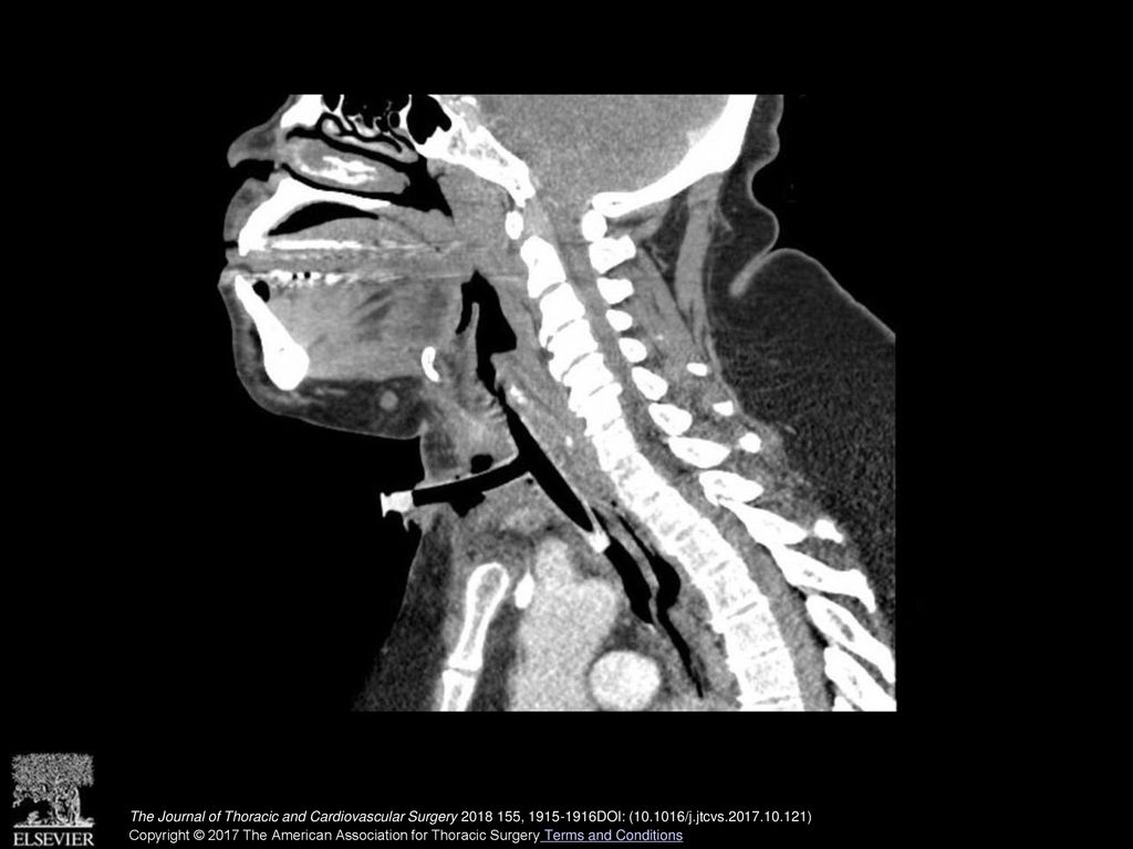 Sagittal CT scan of a patient with a T tube placed for subglottic stenosis.
