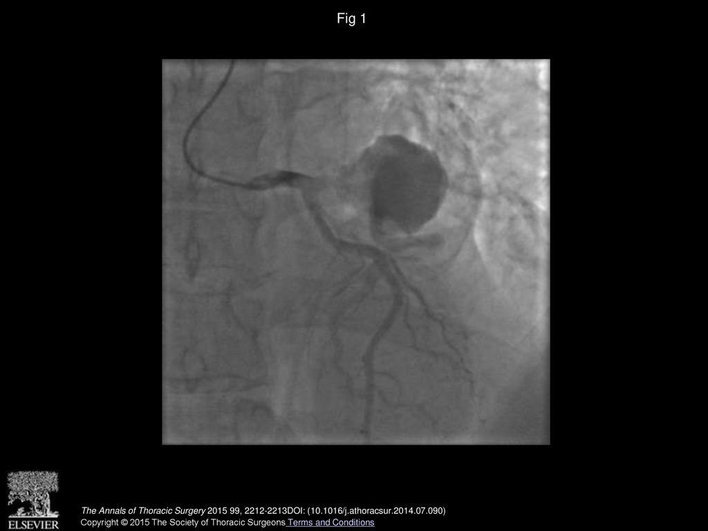 Fig 1 Computed tomography angiogram of the giant aneurysm of the left coronary circumflex artery.