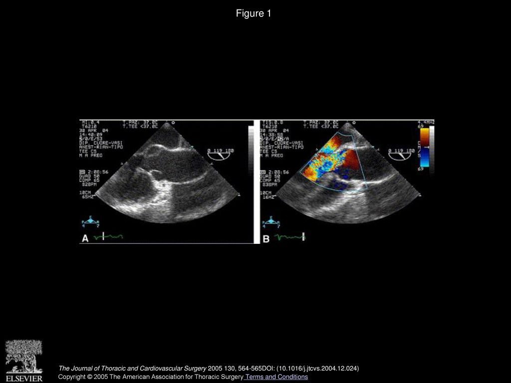 Figure 1 Preoperative transesophageal echocardiograph assessment.