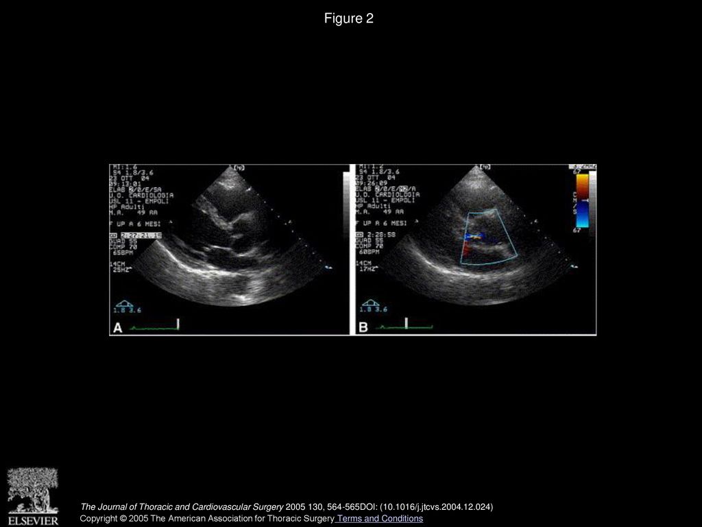 Figure 2 Transesophageal echocardiograph at the 6-month follow-up.