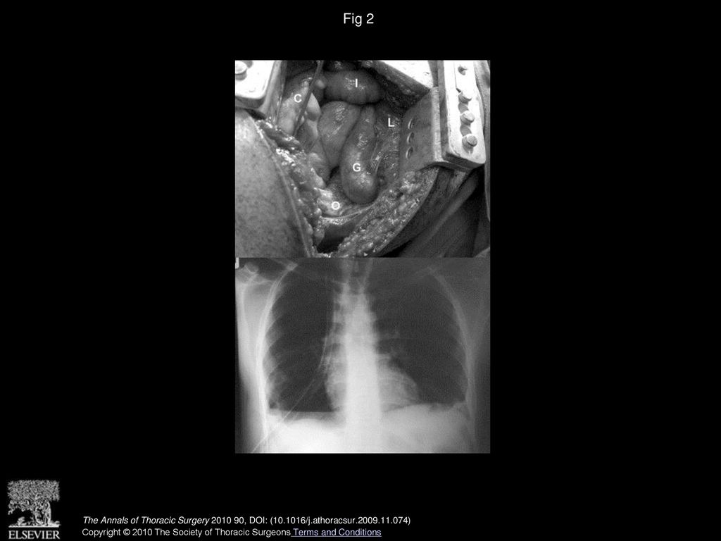 Fig 2 The Annals of Thoracic Surgery , DOI: ( /j.athoracsur )