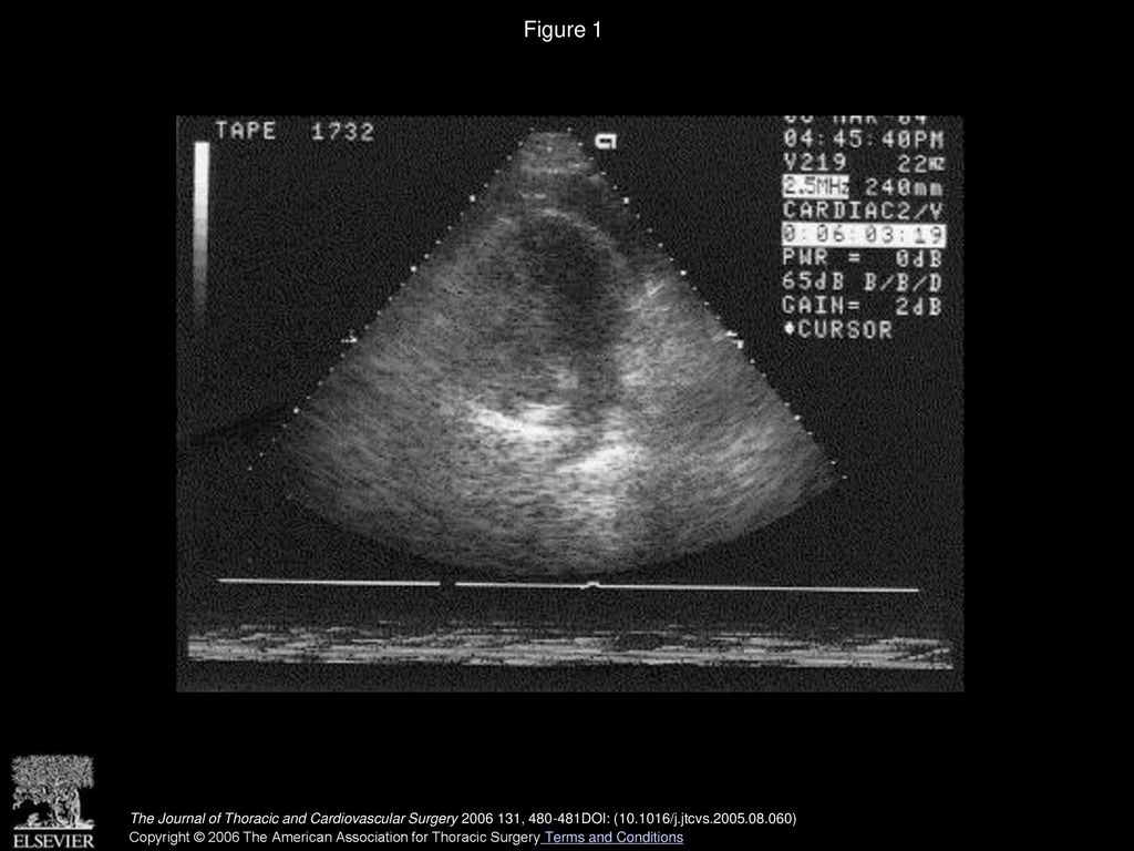 Figure 1 Transthoracic echocardiogram illustrating collapse of Right Ventricle, Left Ventricle and Pericardial Fluid surrounding myocardium.