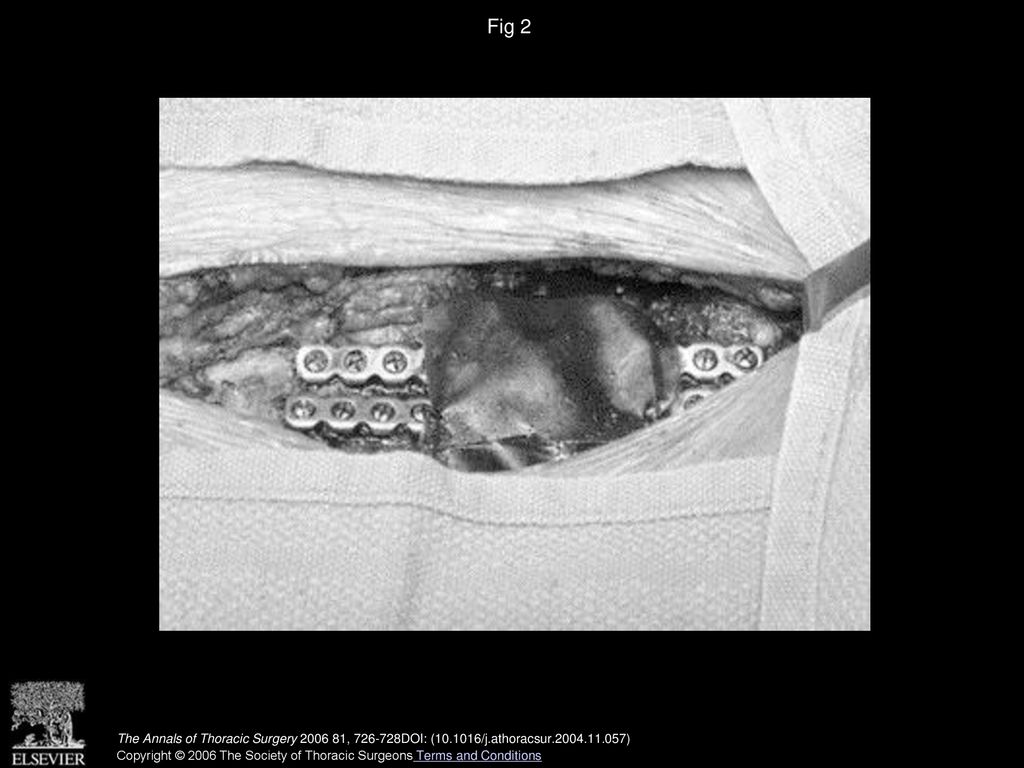 Fig 2 Completed repair. The Annals of Thoracic Surgery , DOI: ( /j.athoracsur )