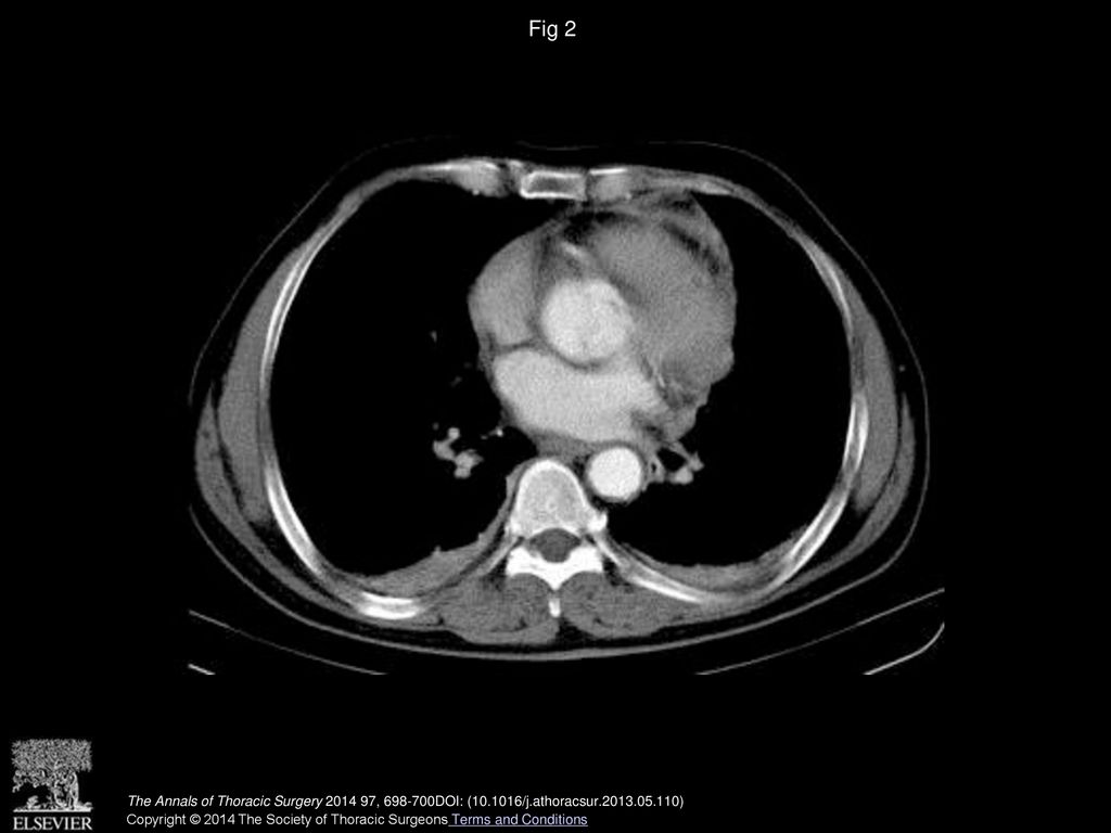 Fig 2 Computed tomographic scan showing no intimal flap or a true-false lumen formation and otherwise normal aorta with some artifacts.