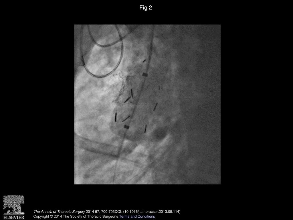 Fig 2 Deployment of a second endovascular stent graft in the ascending aorta.