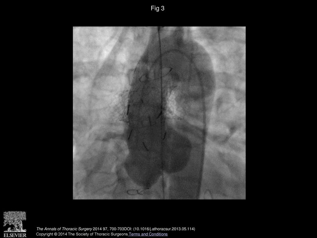 Fig 3 Angiographic image of the ascending aorta demonstrating seal of aortic disruption.