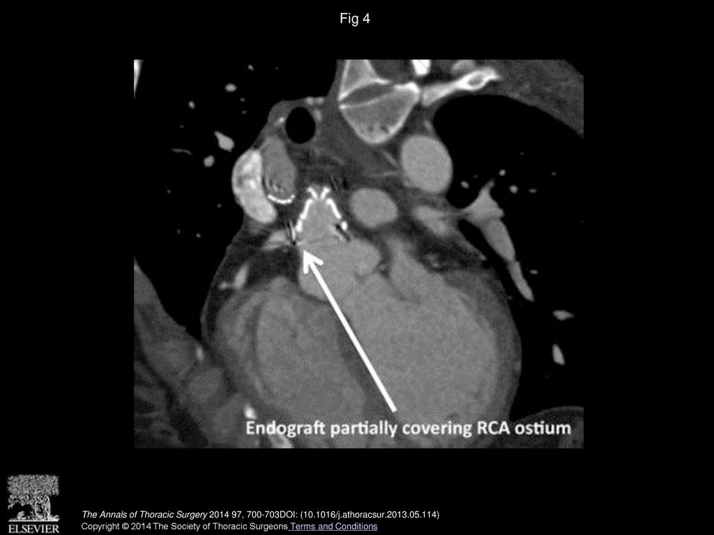Fig 4 Postoperative CT angiogram showing partial coverage of the right coronary artery (RCA) ostium.