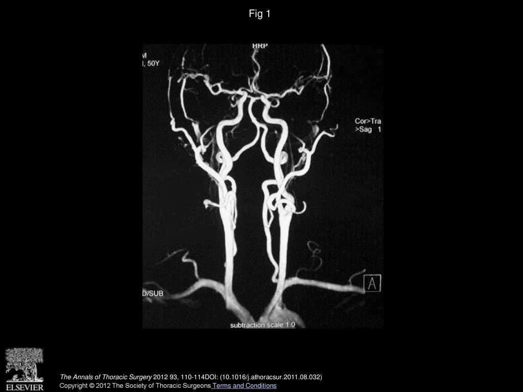 Fig 1 Preoperative magnetic resonance image of neck and cerebral angiography shows complete circle of Willis and good bilateral vertebral arteries.