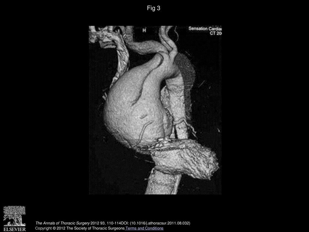 Fig 3 Chronic type A dissection, with a large aneurysm in the ascending aorta that displaces the branches backward.