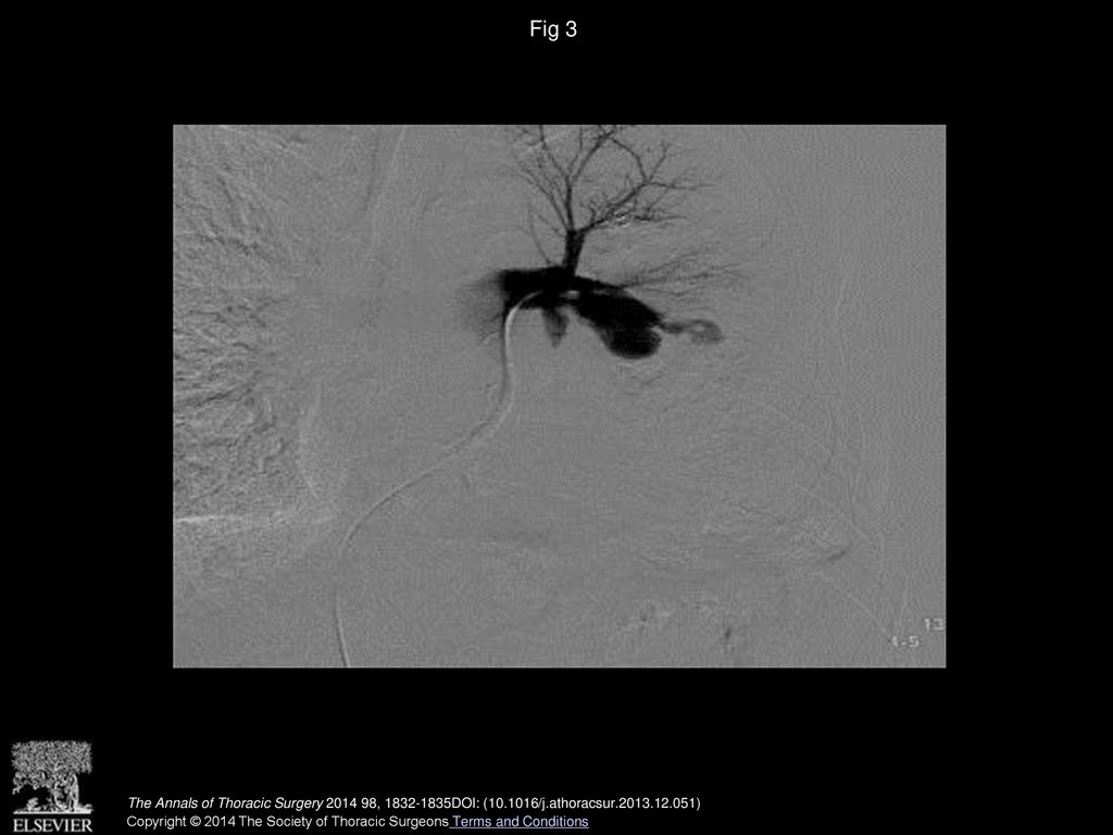 Fig 3 Pulmonary arteriography showed a pseudoaneurysm of the left pulmonary artery at a bifurcation point of the left main pulmonary artery.
