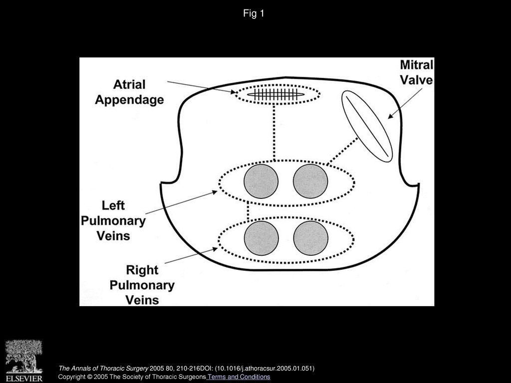 Fig 1 Diagram of endocardial ablation lines placed in left atrium.