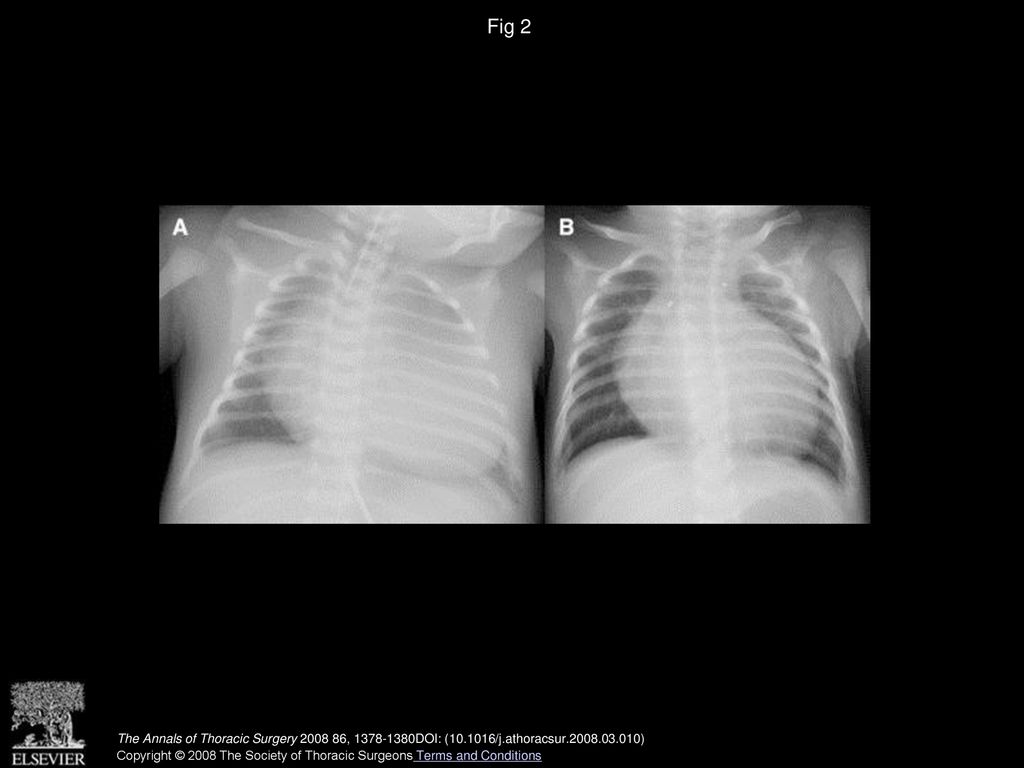 Fig 2 Chest roentgenogram (A) before and (B) after the Norwood procedure combined with the Starnes procedure.