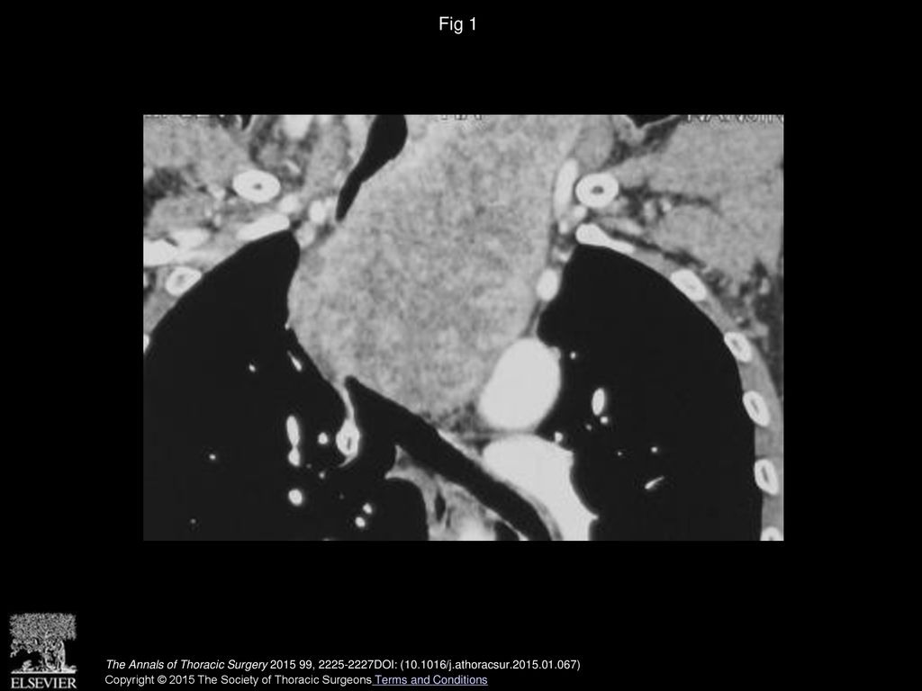Fig 1 Chest computed tomography shows tracheal compression with narrowing of the lumen.