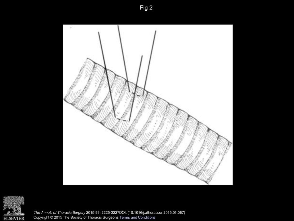 Fig 2 The 3-0 Prolene (Ethicon, Somerville, NJ) vertical sutures are placed through the anterior tracheal fascia through two cartilage rings.