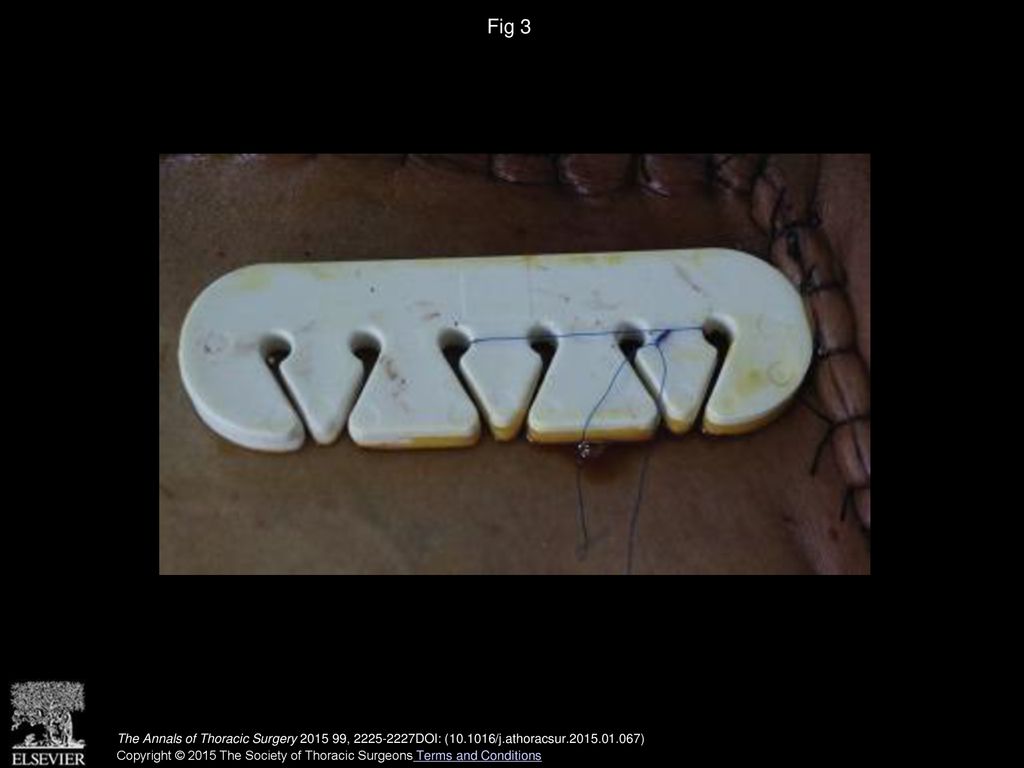 Fig 3 The sutures are then sequentially passed through the sternal plate and twisted around a tension suture plate.