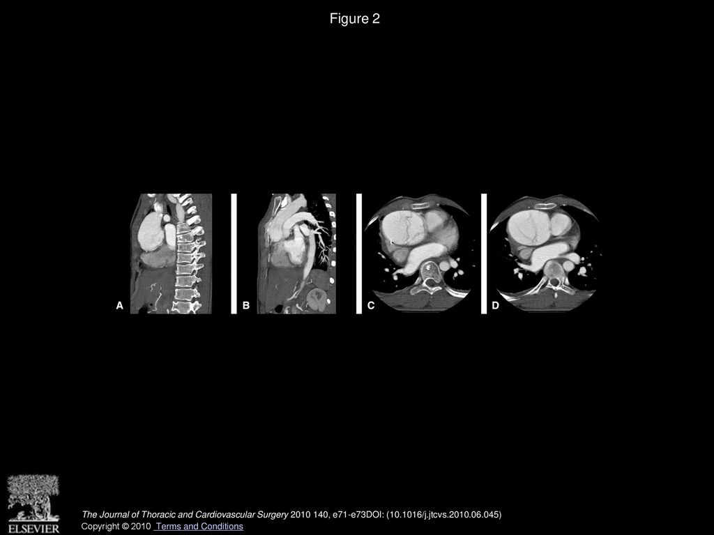 Figure 2 Computed tomography scan shows a large ascending aortic aneurysm with dissection (A–D) abating the sternum (B–D).