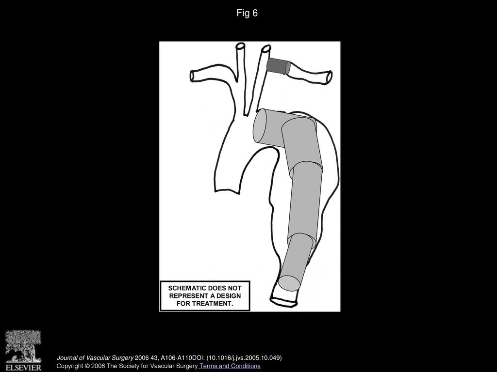 Fig 6 CPT Code Journal of Vascular Surgery , A106-A110DOI: ( /j.jvs )