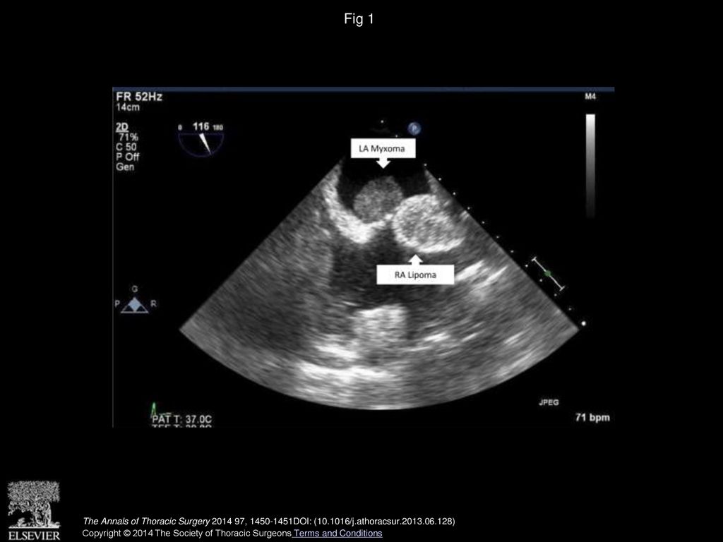 Fig 1 A transthoracic echocardiogram shows the left atrial (LA) myxoma and the right atrial (RA) lipoma.