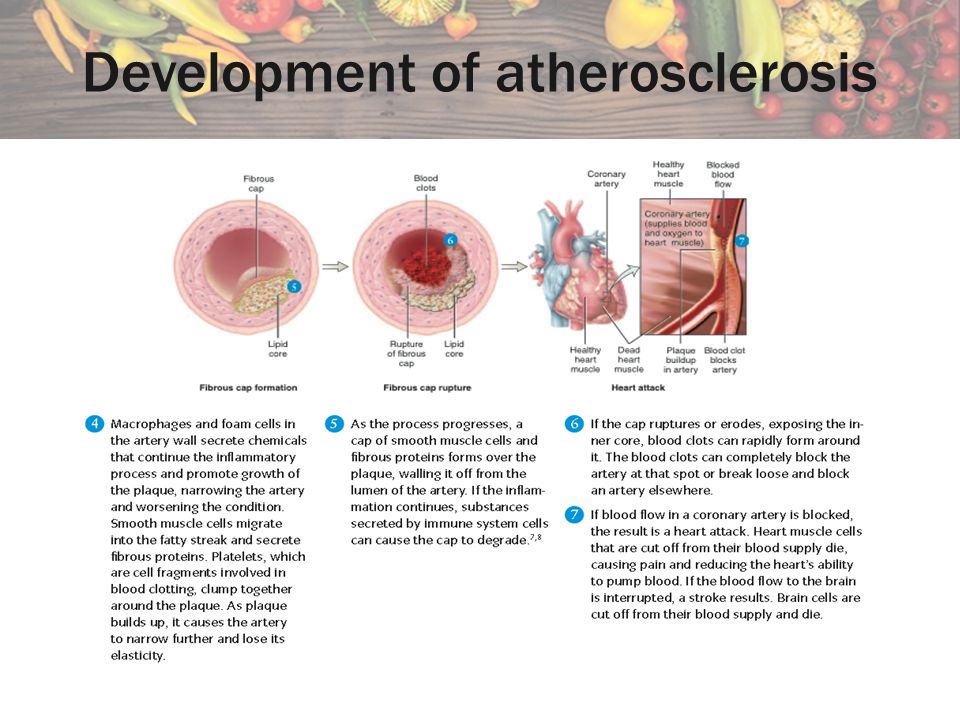 Development of atherosclerosis