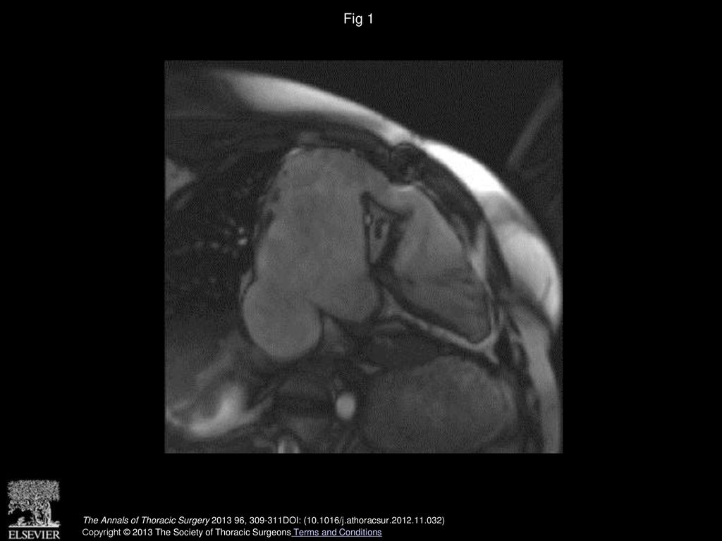 Fig 1 Preoperative cardiovascular magnetic resonance.