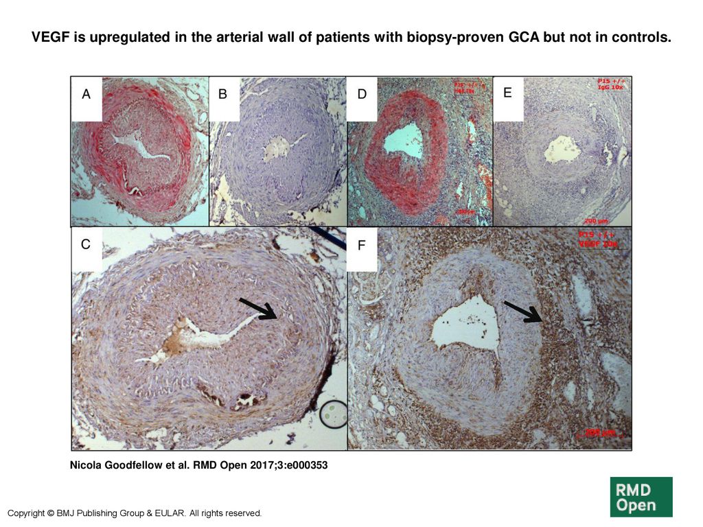 VEGF is upregulated in the arterial wall of patients with biopsy-proven GCA but not in controls.