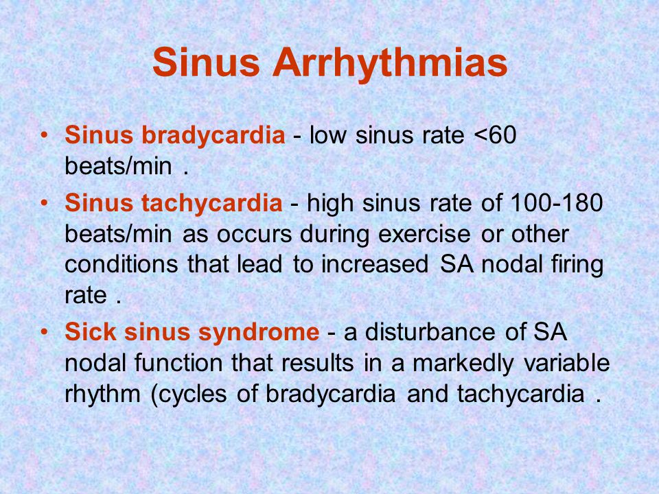 Sinus Arrhythmias Sinus bradycardia - low sinus rate <60 beats/min.