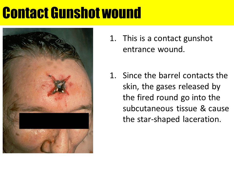 Contact Gunshot wound This is a contact gunshot entrance wound.