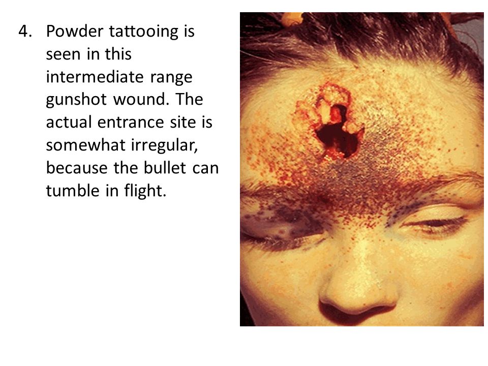 Powder tattooing is seen in this intermediate range gunshot wound